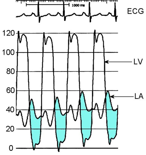 mitral valve area by catheterization